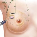tumore-mammella